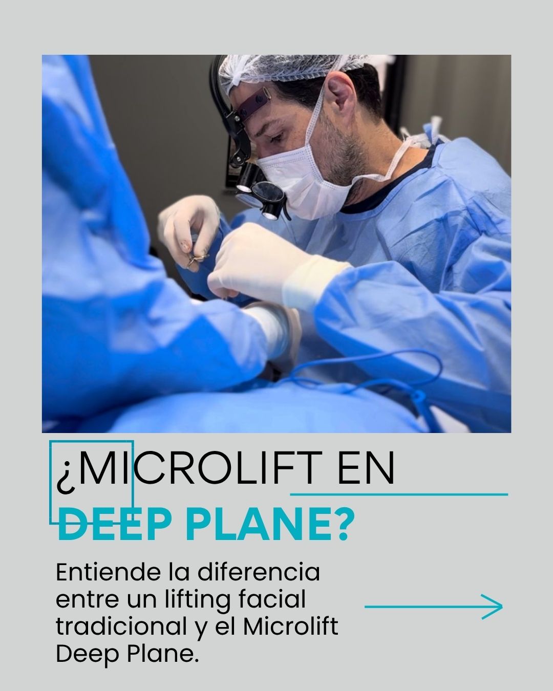 ¿El Microlift se realiza en el Deep Plane? Entiende la diferencia entre un lifting facial tradicional y el Microlift Deep Plane.