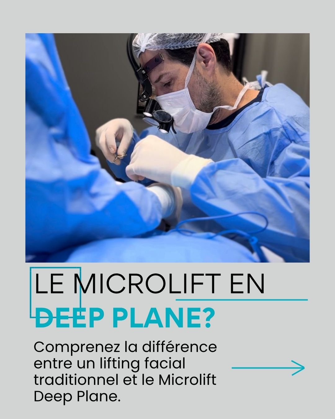 Le Microlift est-il réalisé en Deep Plane ? Comprenez la différence entre un lifting facial traditionnel et le Microlift Deep Plane.