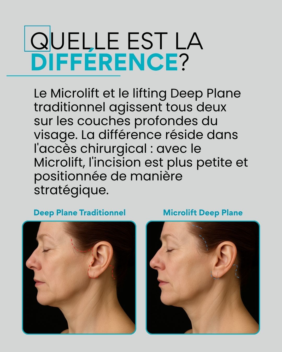Quelle est la différence ? Le Microlift et le lifting Deep Plane traditionnel agissent tous deux sur les couches profondes du visage. La différence réside dans l'accès chirurgical : avec le Microlift, l'incision est plus petite et positionnée de manière stratégique.