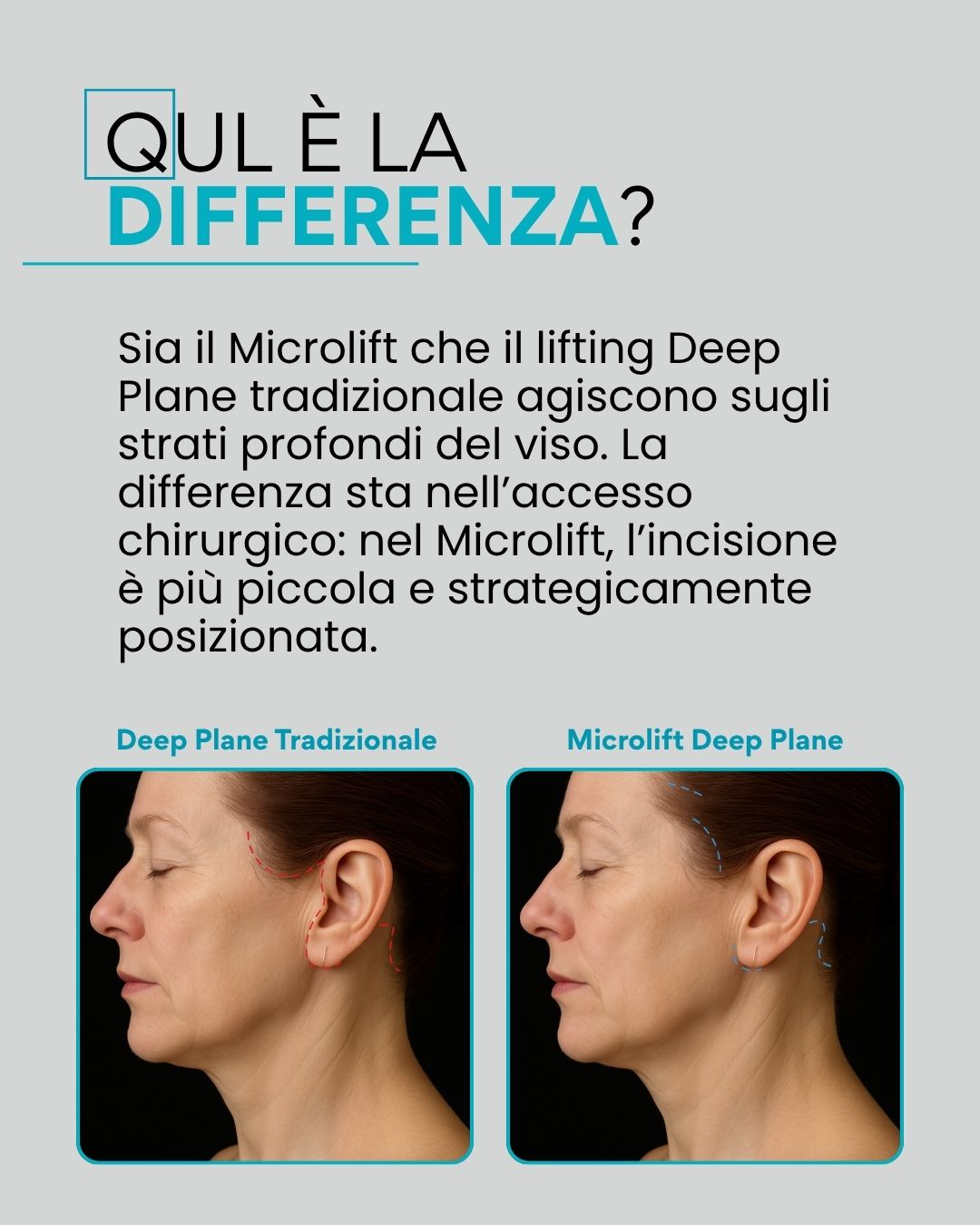 Qual è la differenza? Sia il Microlift che il lifting Deep Plane tradizionale agiscono sugli strati profondi del viso. La differenza sta nell’accesso chirurgico: nel Microlift, l’incisione è più piccola e strategicamente posizionata.