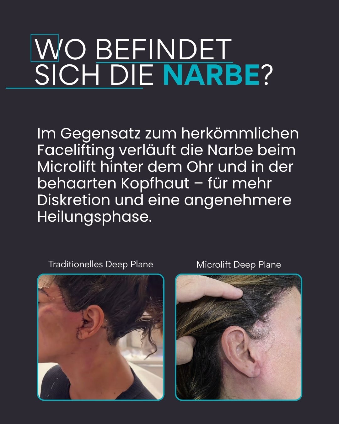 Wo befindet sich die Narbe? Im Gegensatz zum herkömmlichen Facelifting verläuft die Narbe beim Microlift hinter dem Ohr und in der behaarten Kopfhaut – für mehr Diskretion und eine angenehmere Heilungsphase.