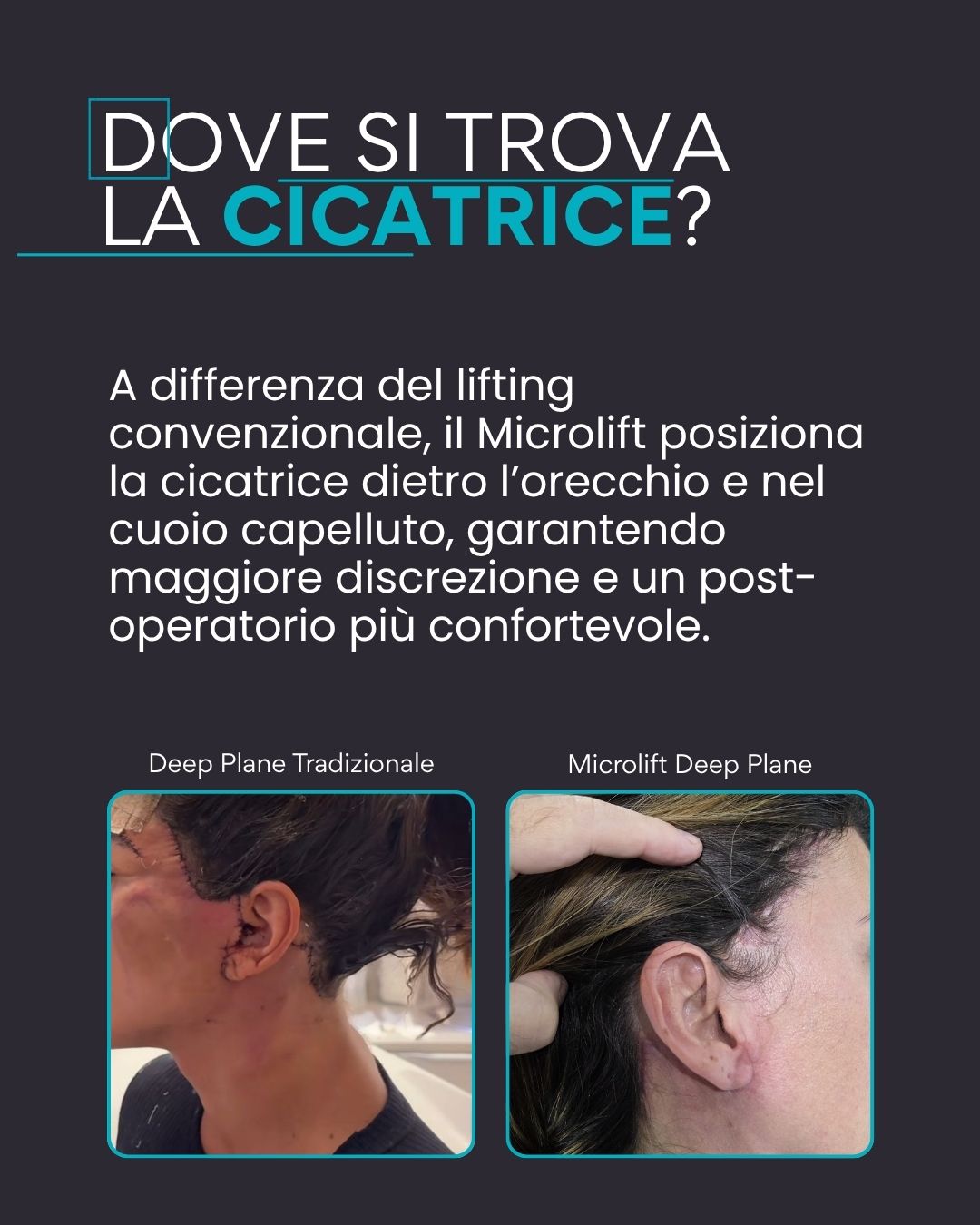 Dove si trova la cicatrice? A differenza del lifting convenzionale, il Microlift posiziona la cicatrice dietro l’orecchio e nel cuoio capelluto, garantendo maggiore discrezione e un post-operatorio più confortevole.
