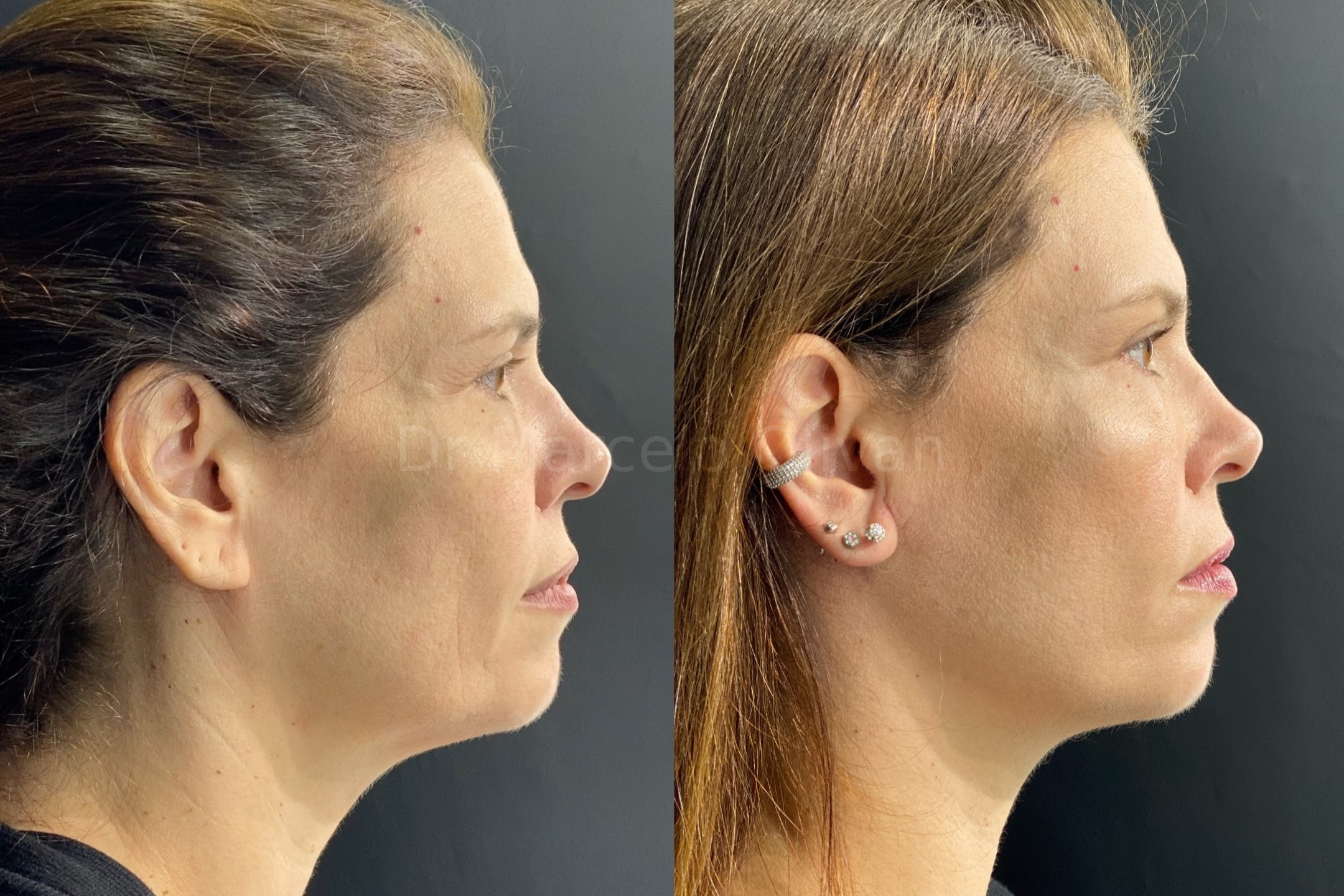 Antes e depois - visão lateral