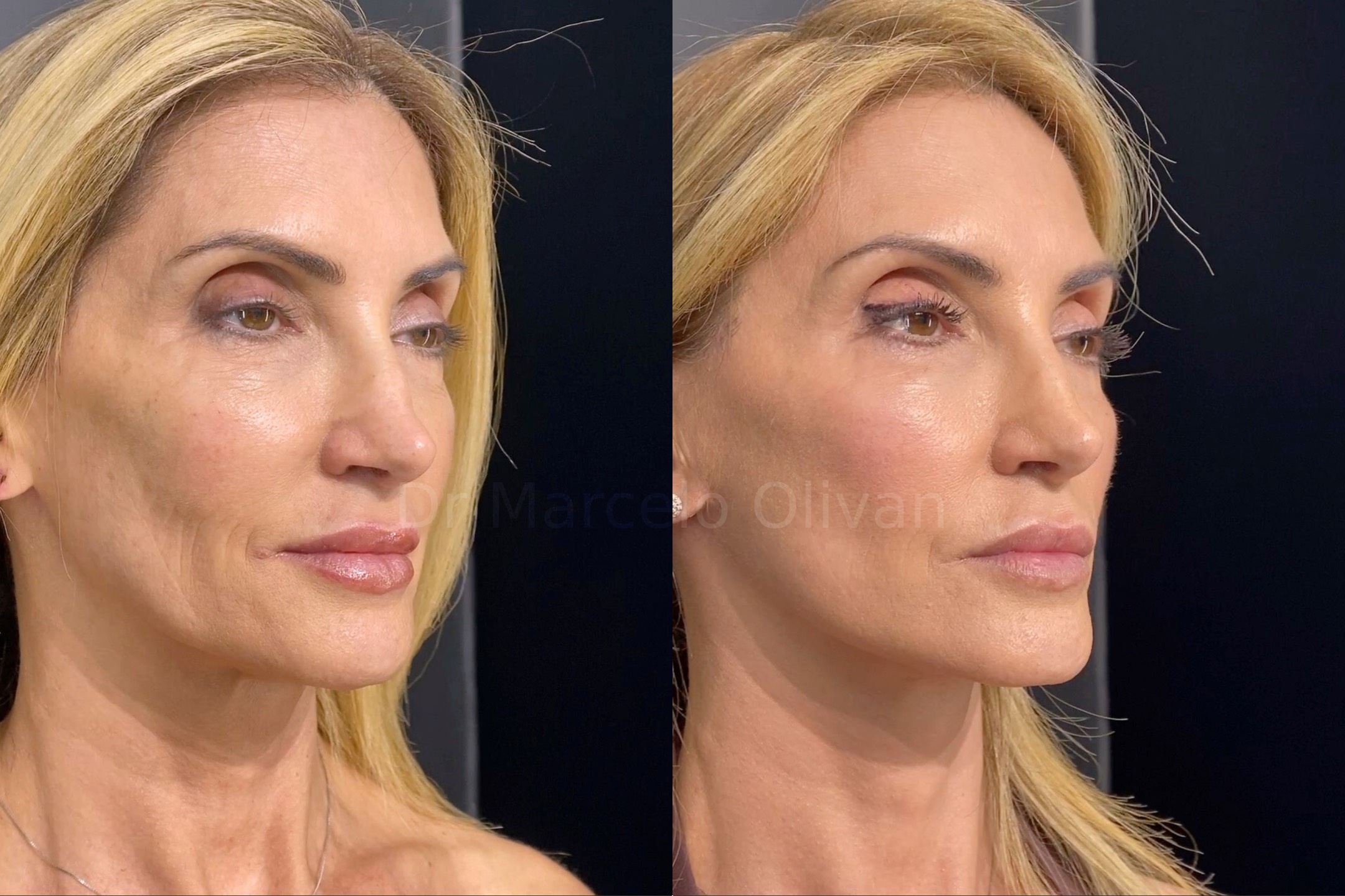 Result Gisele - Angle View