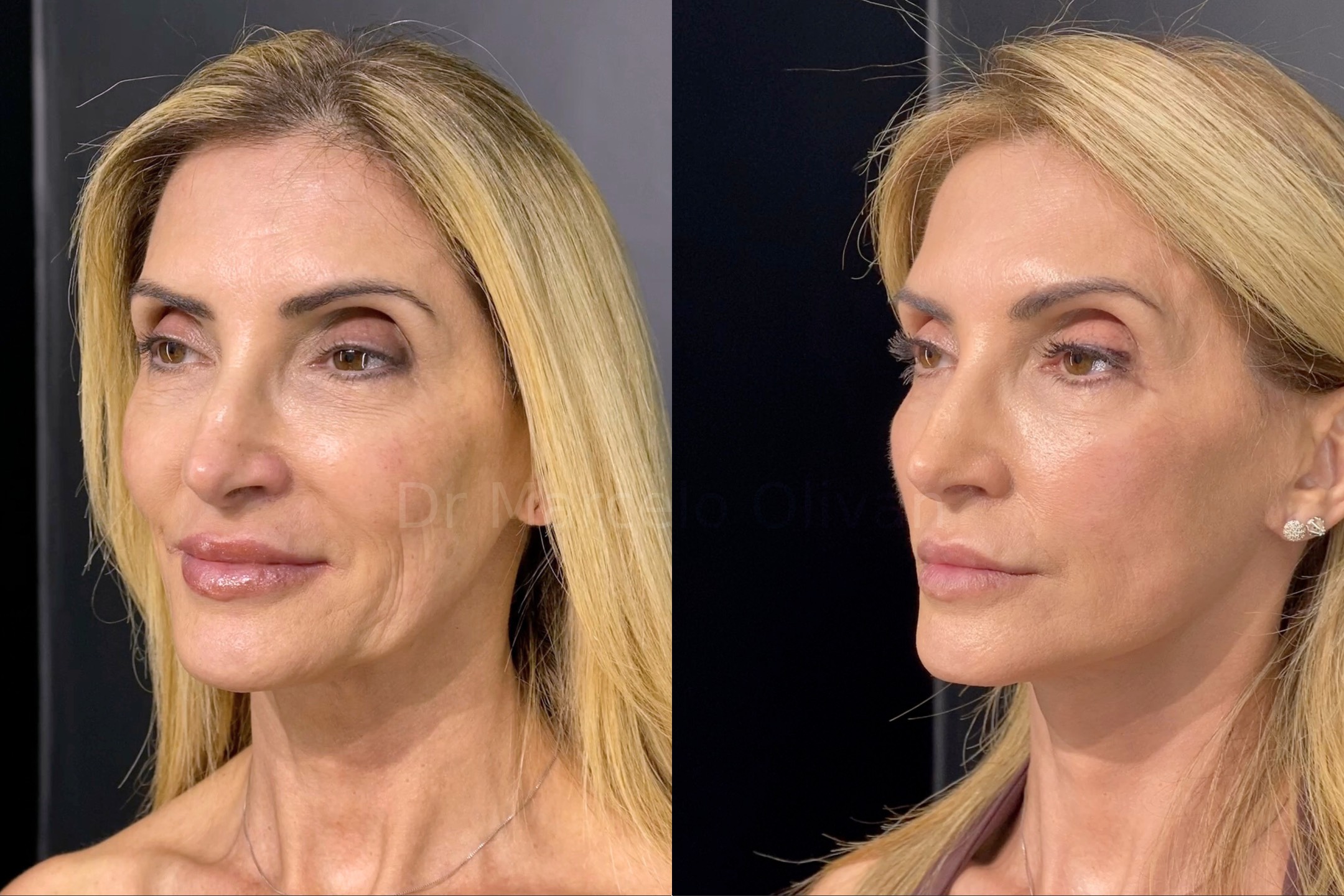 Result Gisele - Angle View