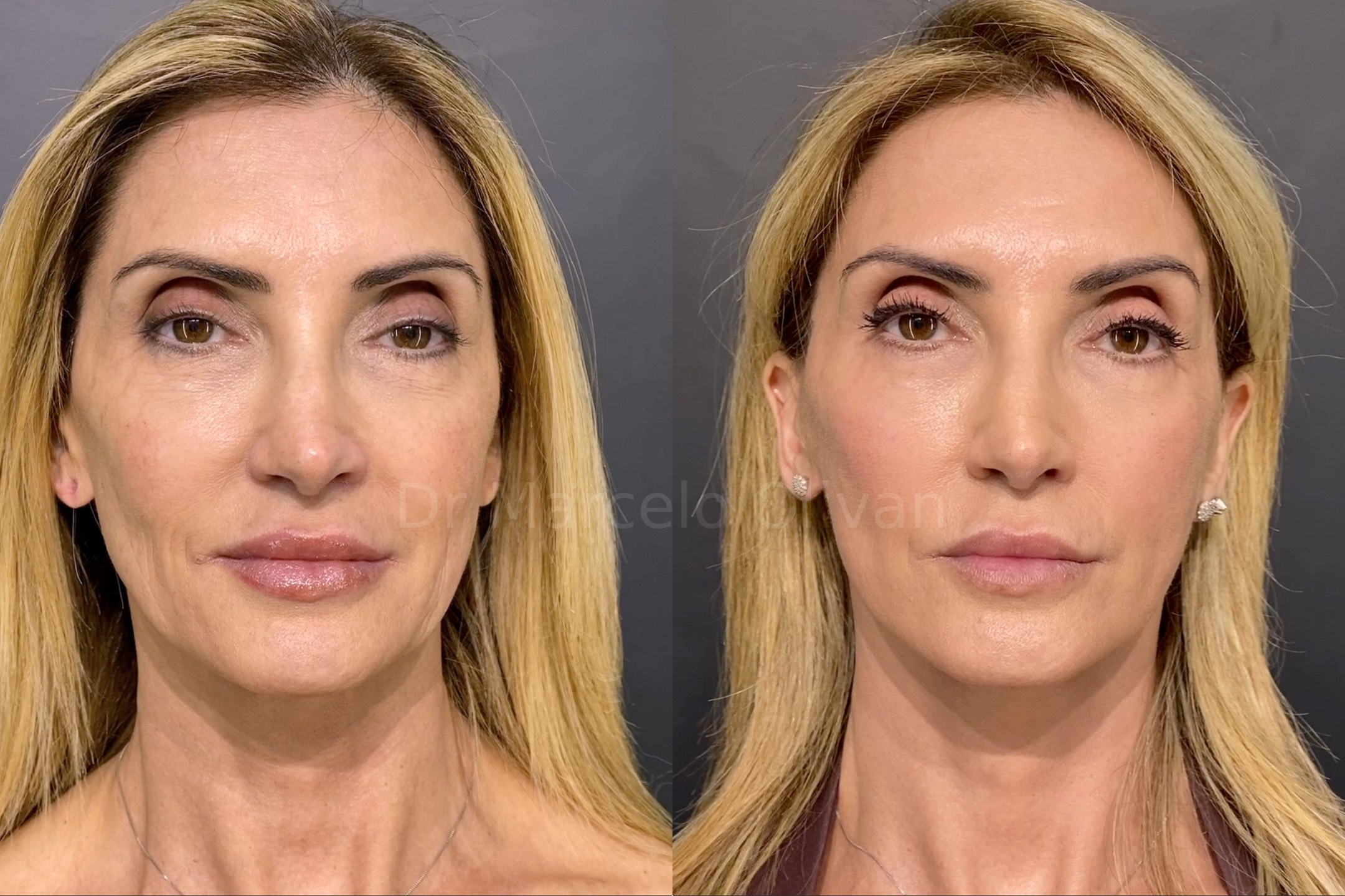 Result Gisele - Front View