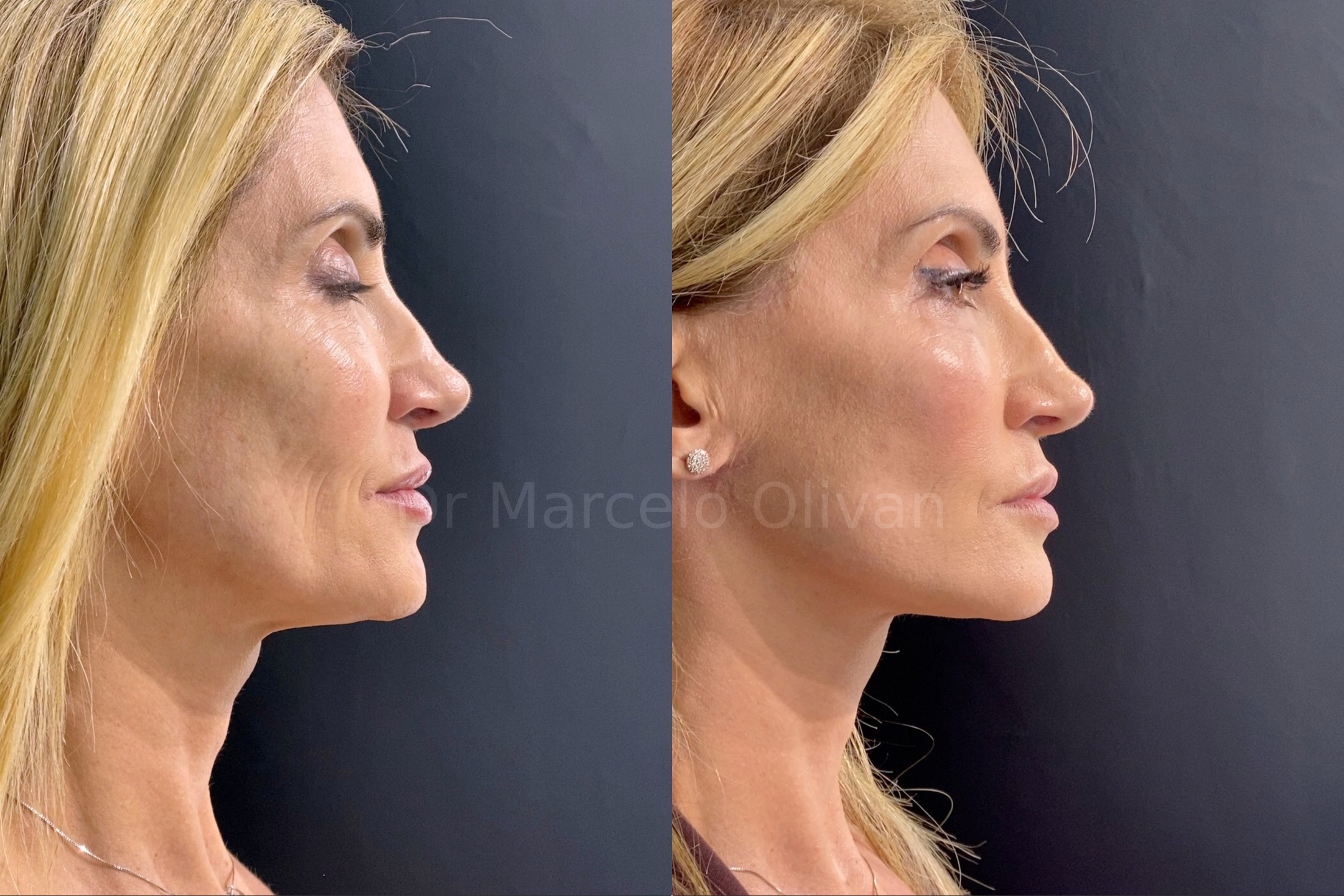 Result Gisele - Side View