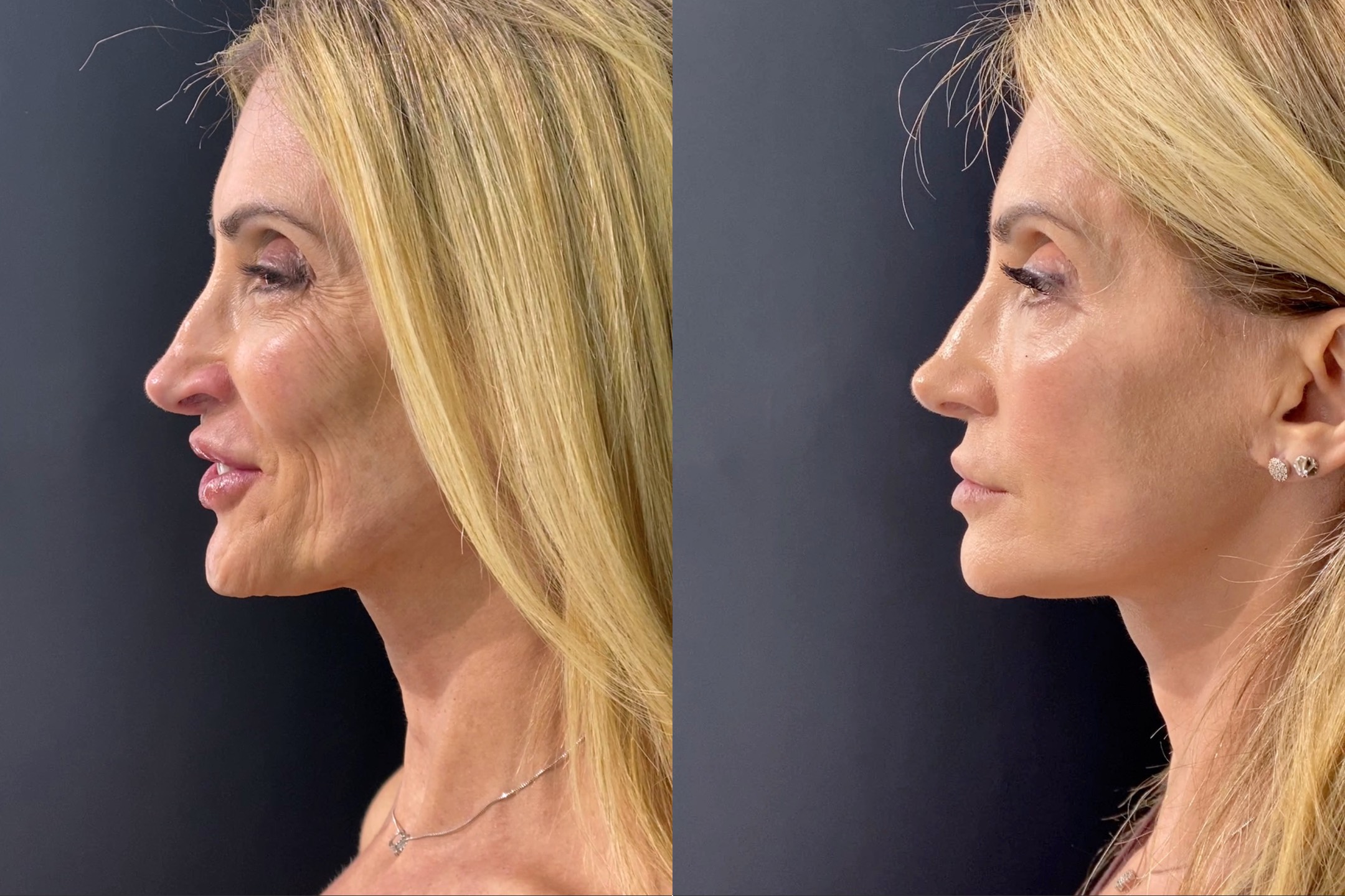 Result Gisele - Side View