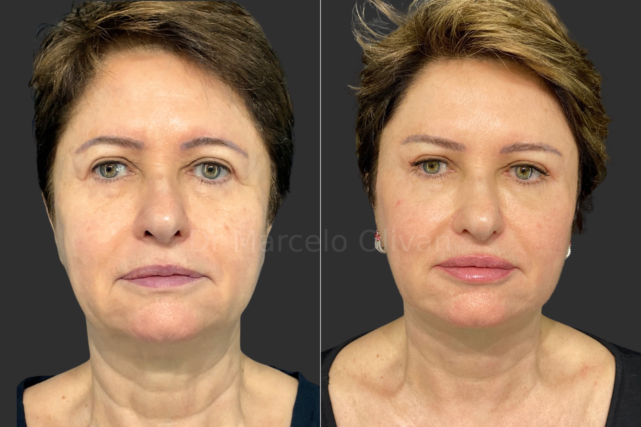 Antes e depois - visão frontal