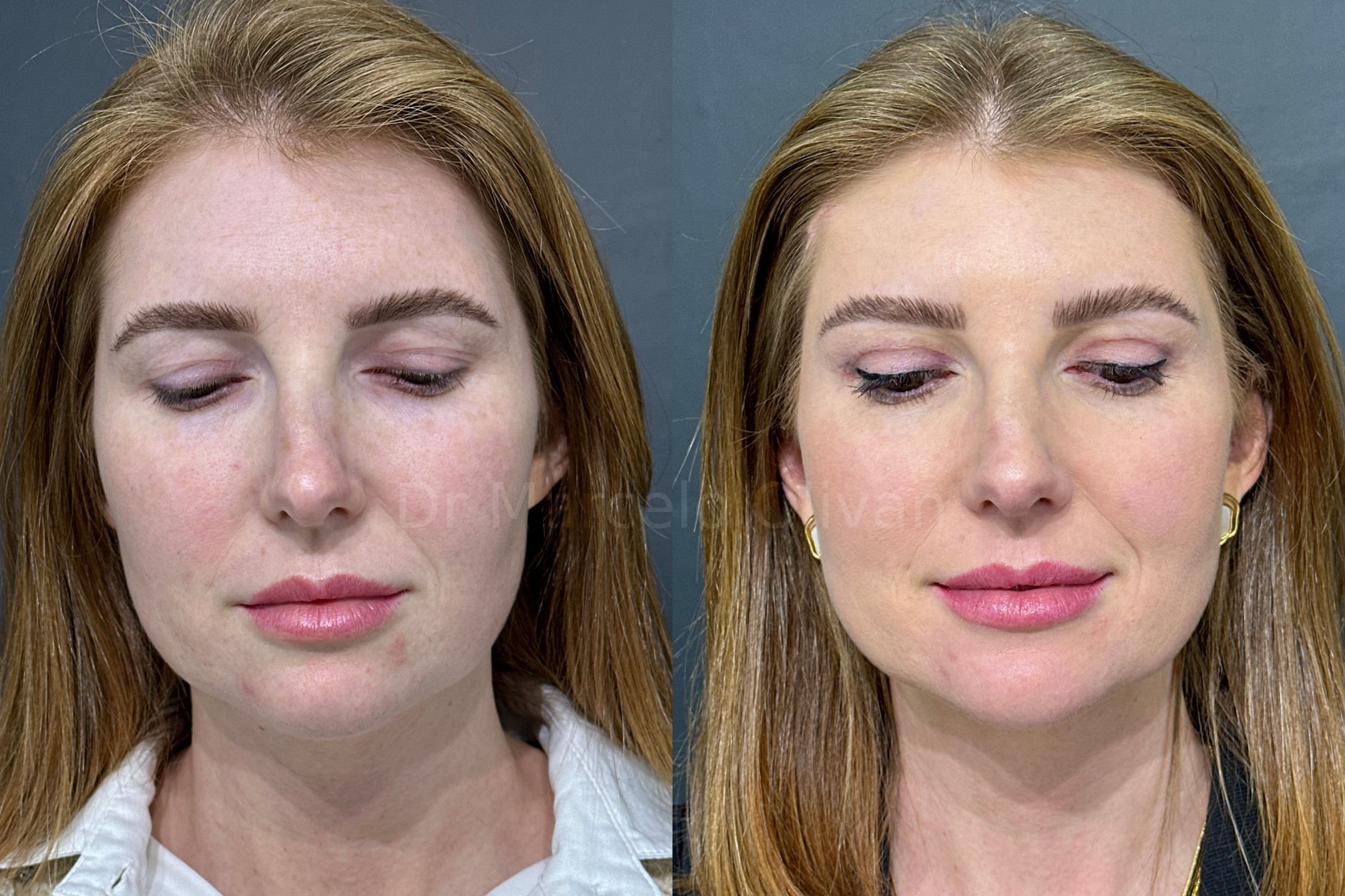 Before and after - frontal view C