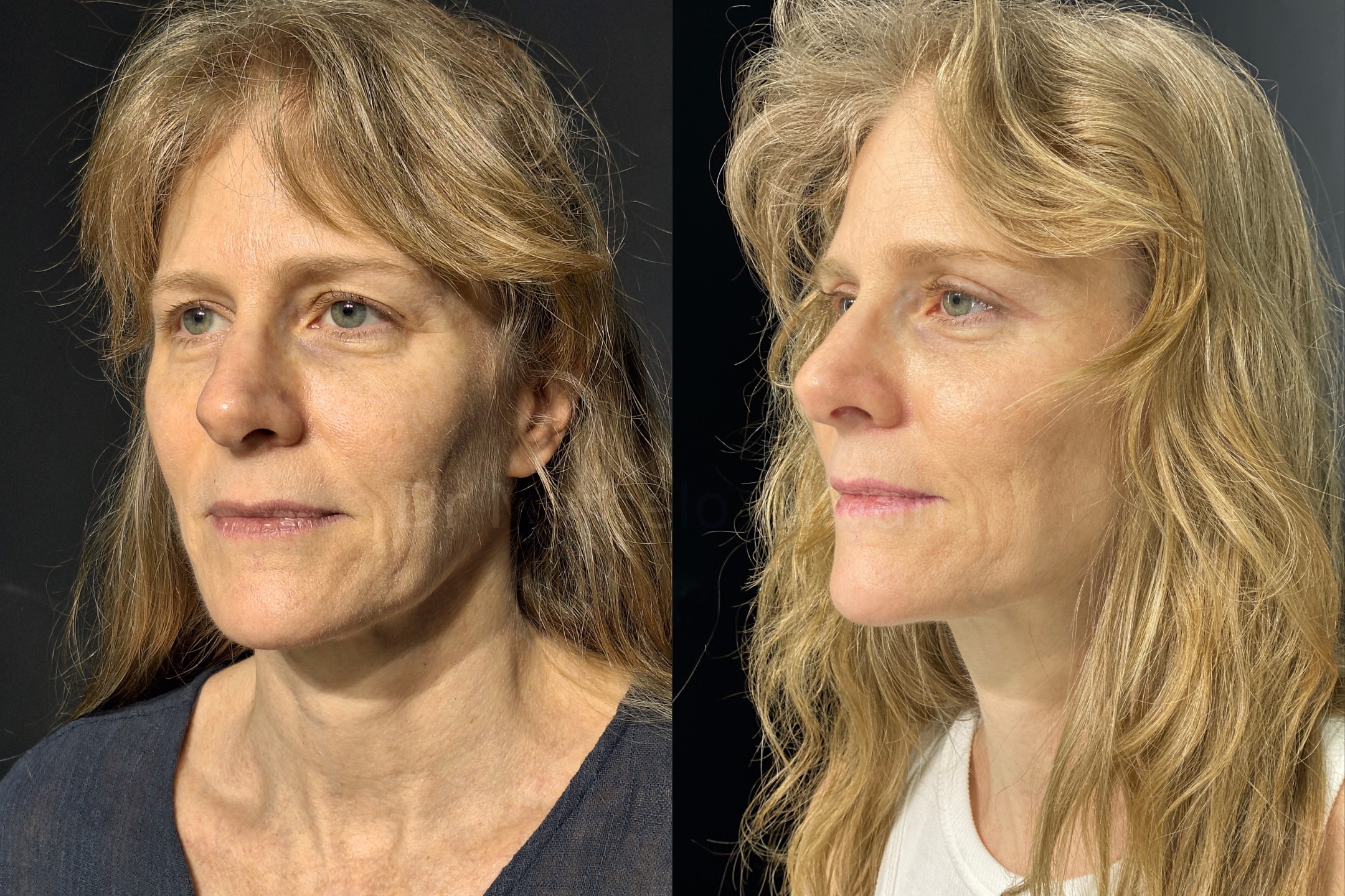 Before and after - angle view A (Stage 1)