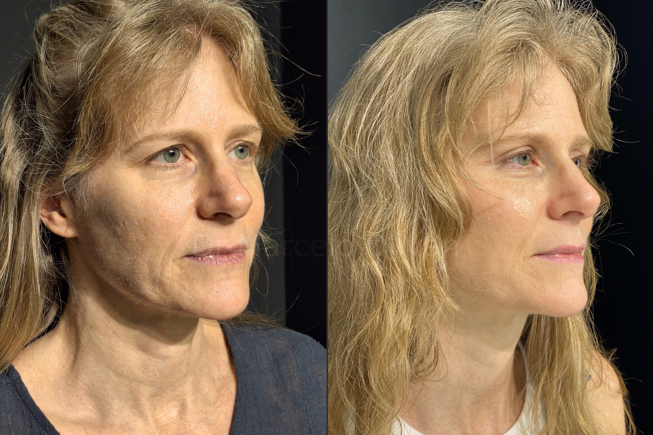 Before and after - angle view B (Stage 1)