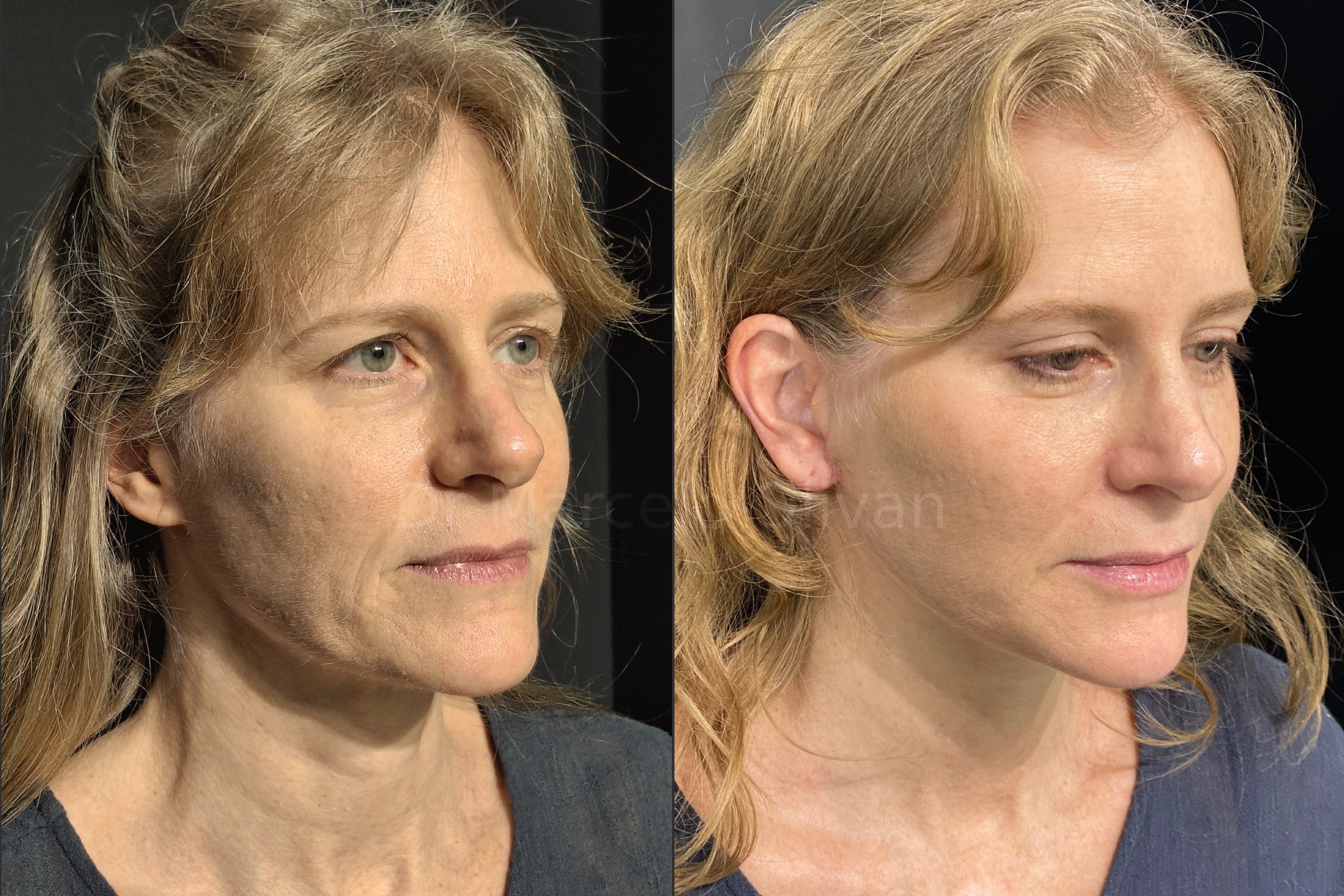 Before and after - angle view D (Stage 2)