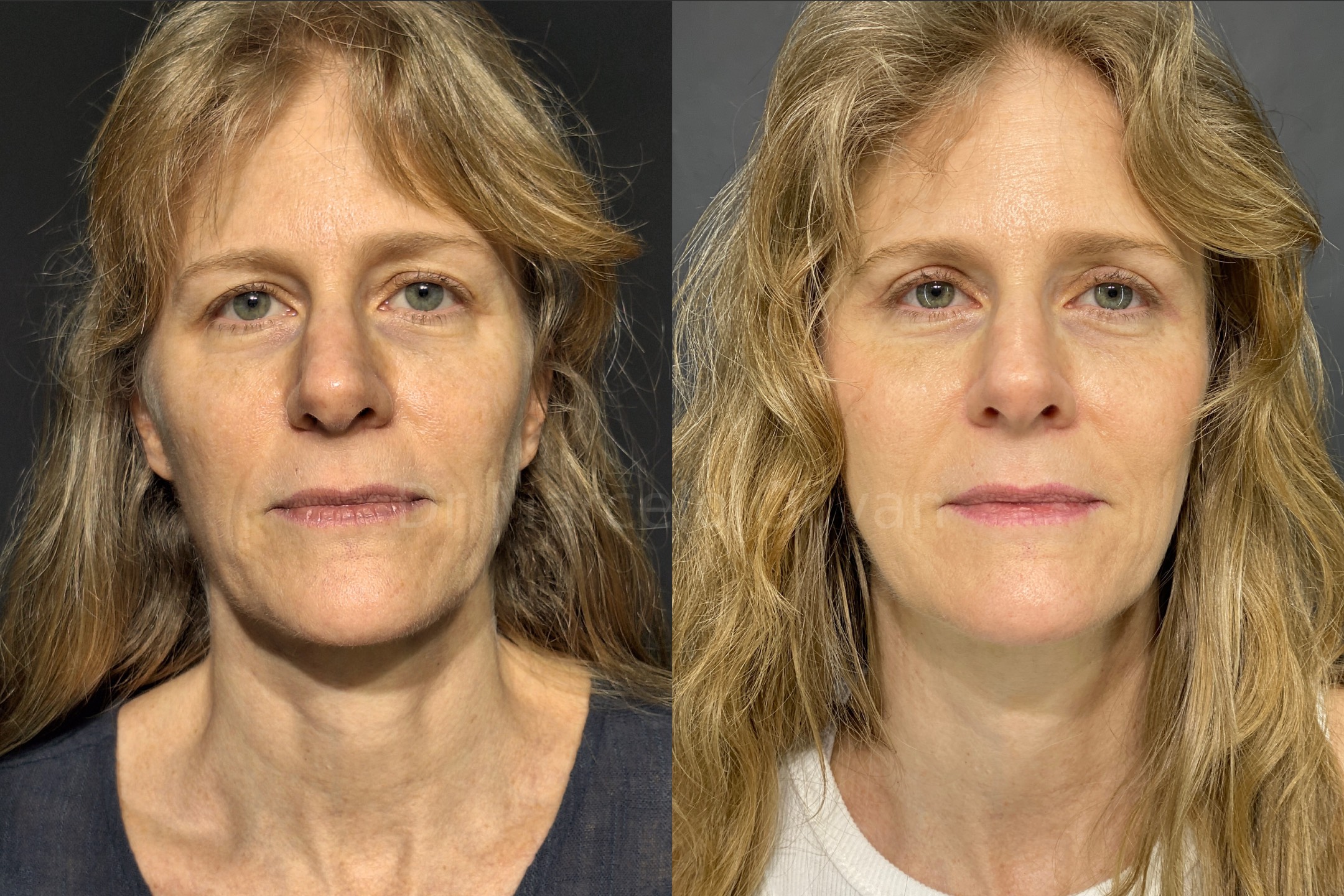 Before and after - frontal view (Stage 1)