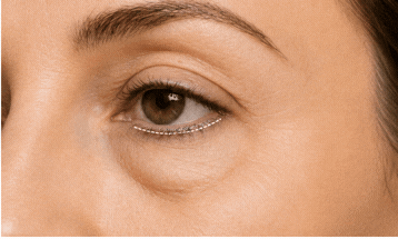 Anatomical illustration — Lower Blepharoplasty