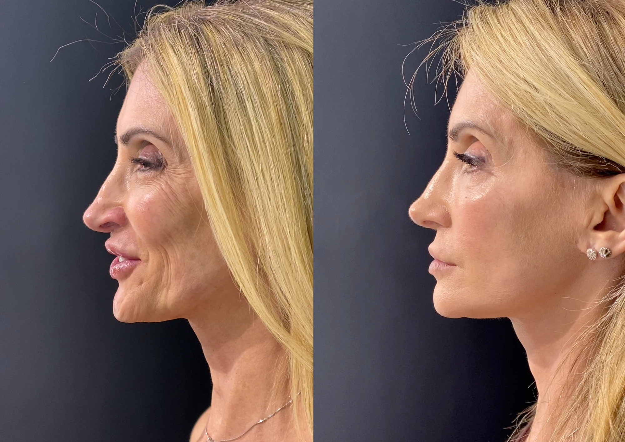 Before and after — Right profile