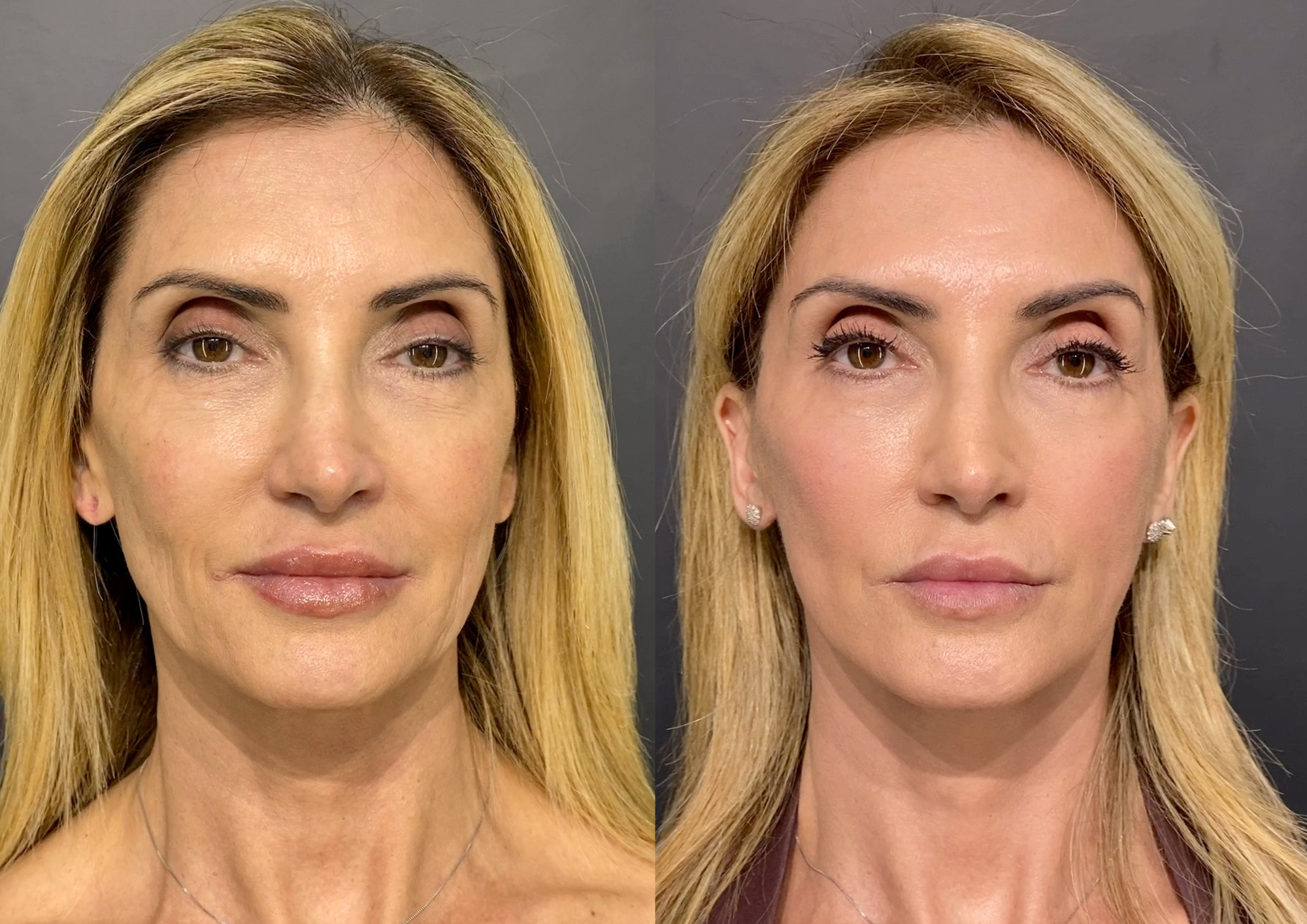 Before and after — Left profile