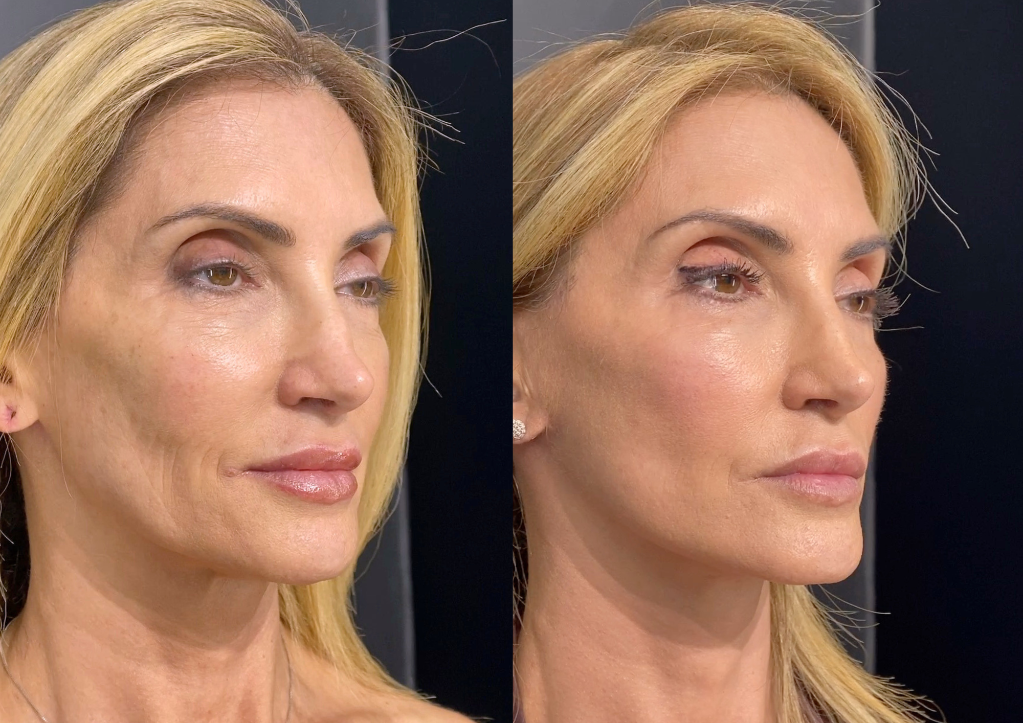 Before and after — 45° right