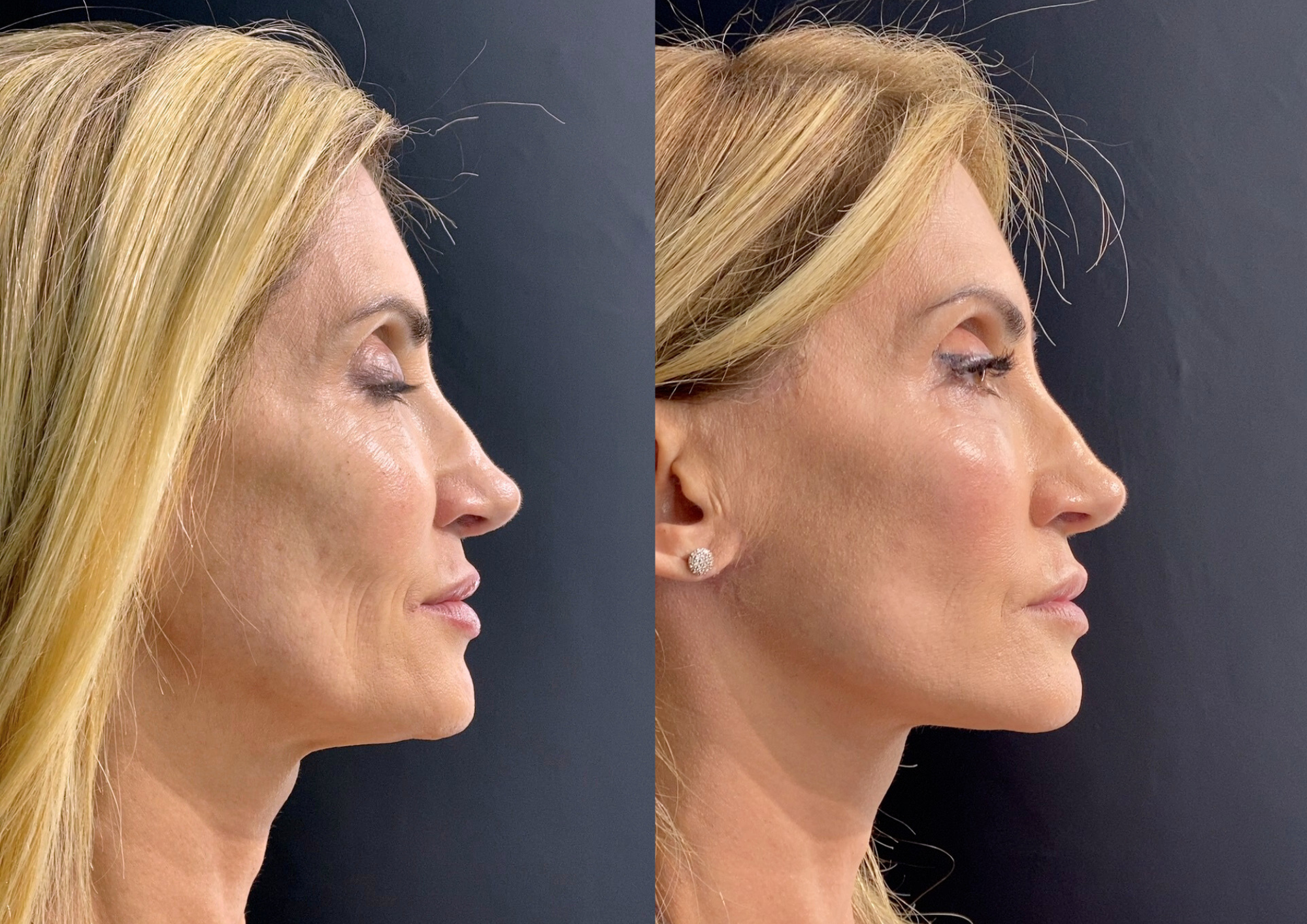 Before and after — 45° left