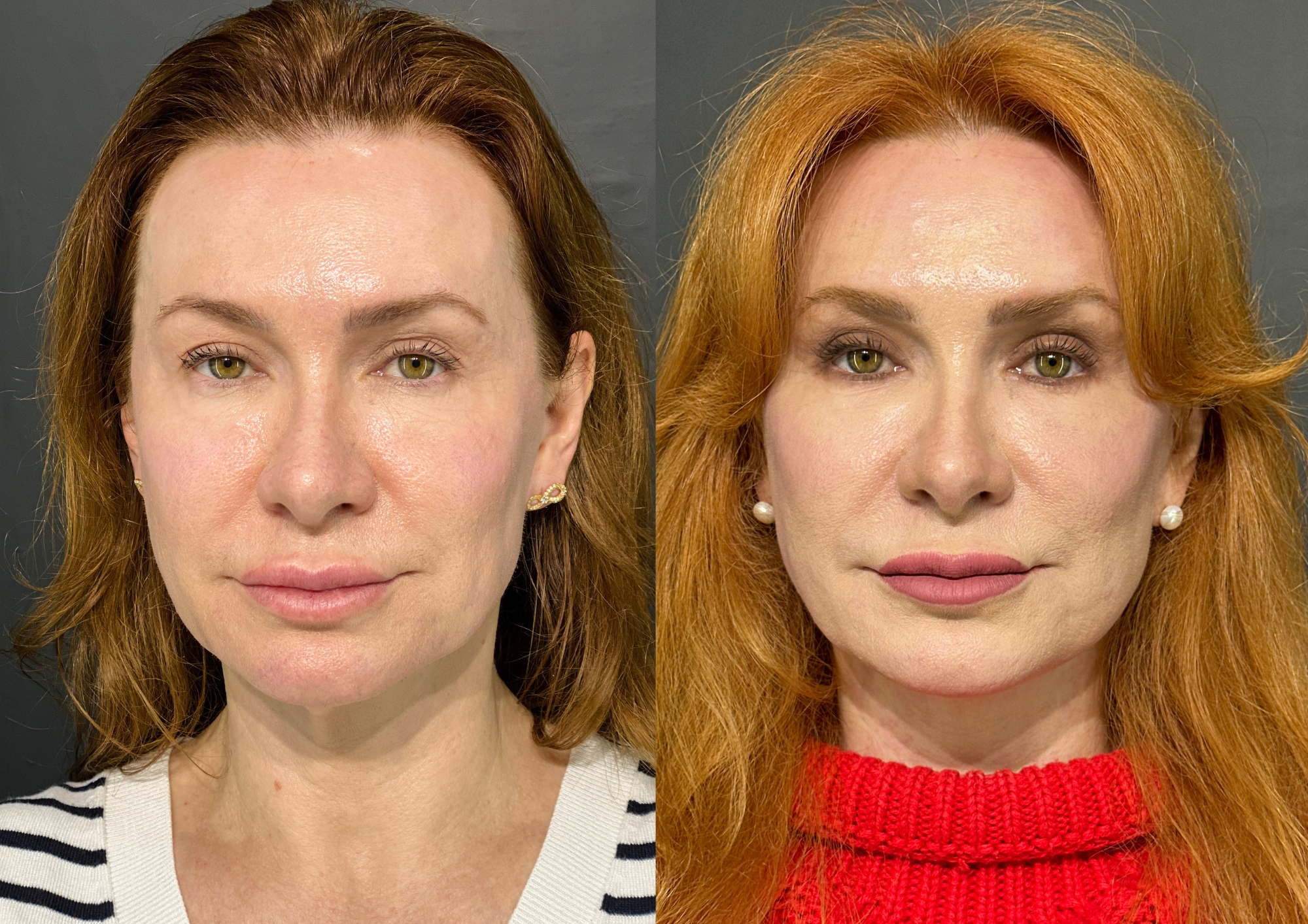 Before and after — Front