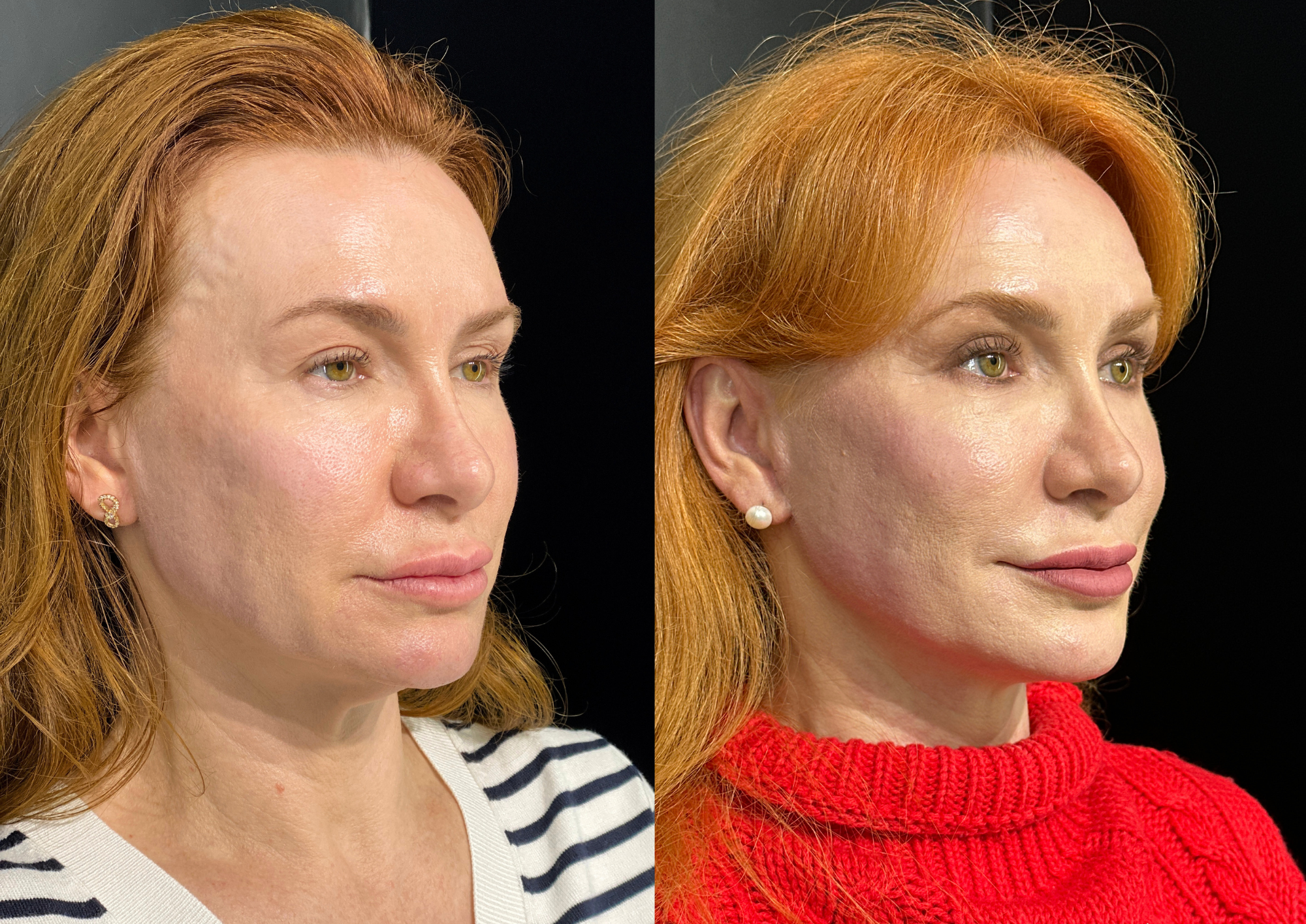Before and after — Right profile