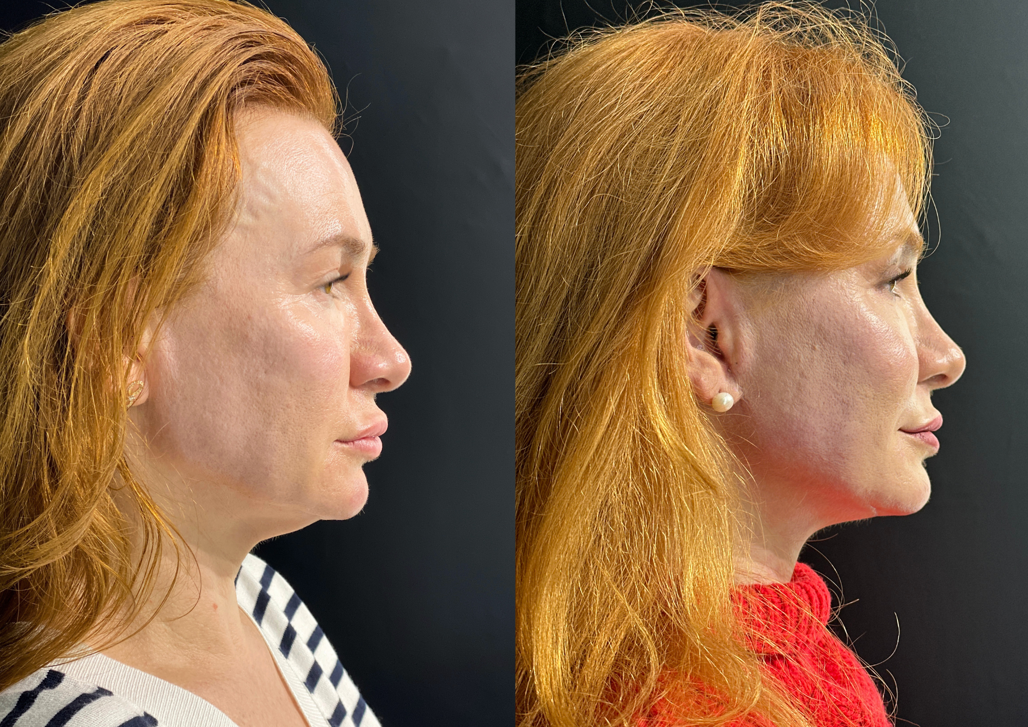 Before and after — Left profile