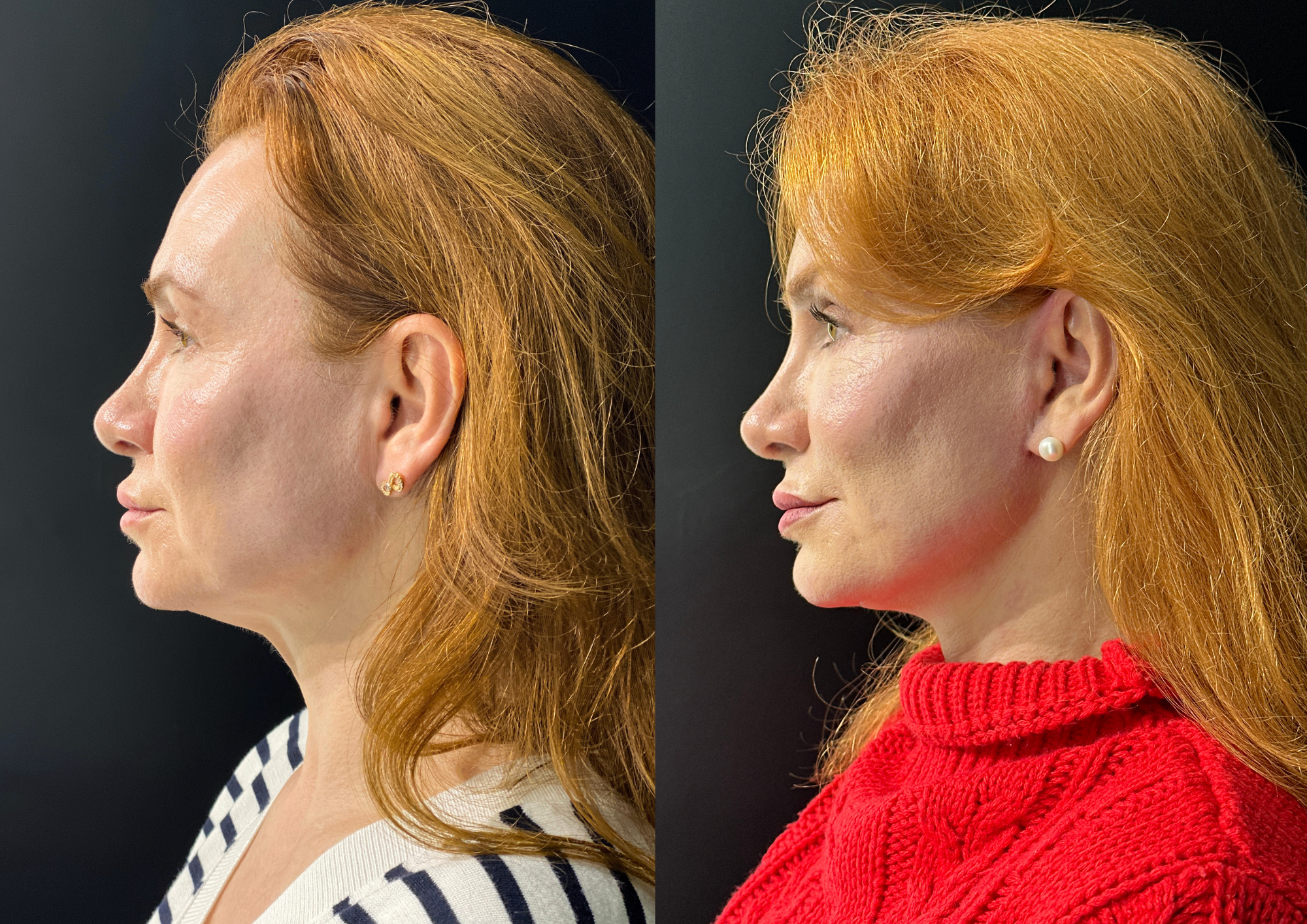 Before and after — 45° right