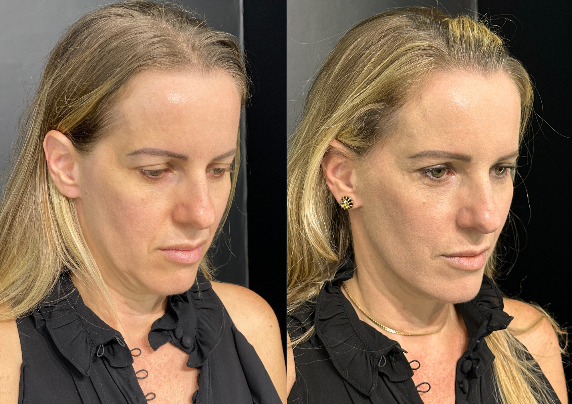 Before and after — Front