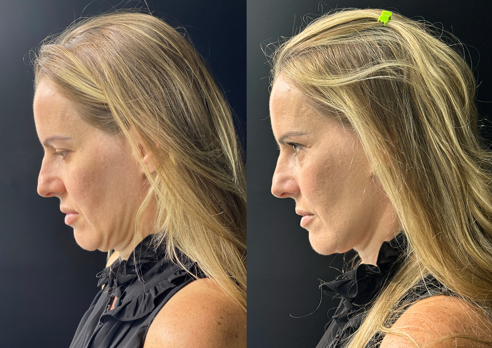 Before and after — Right profile