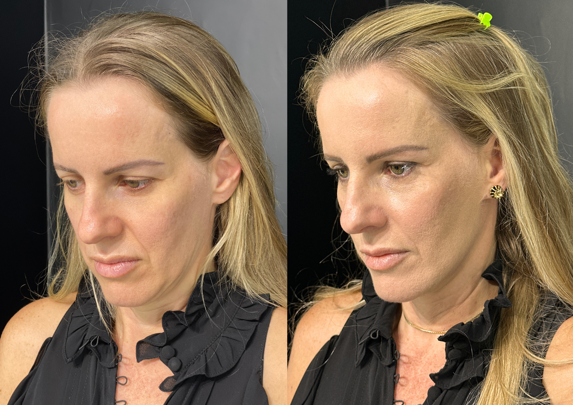 Before and after — Left profile