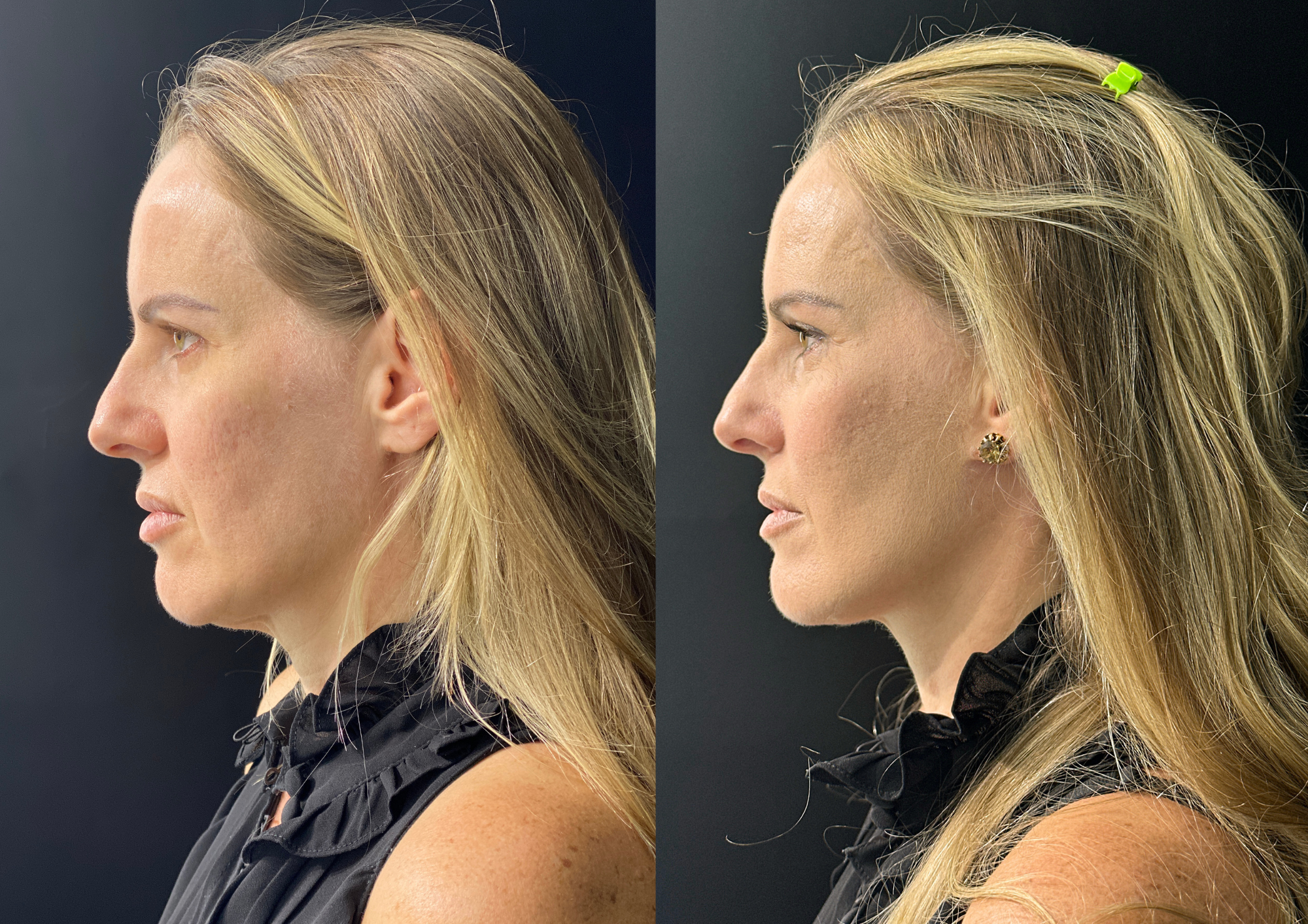 Before and after — 45° right