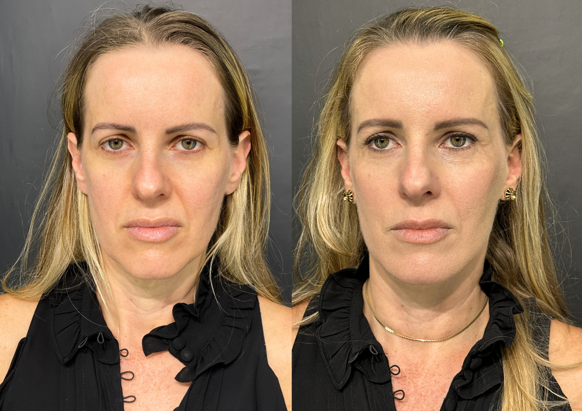 Before and after — 45° left