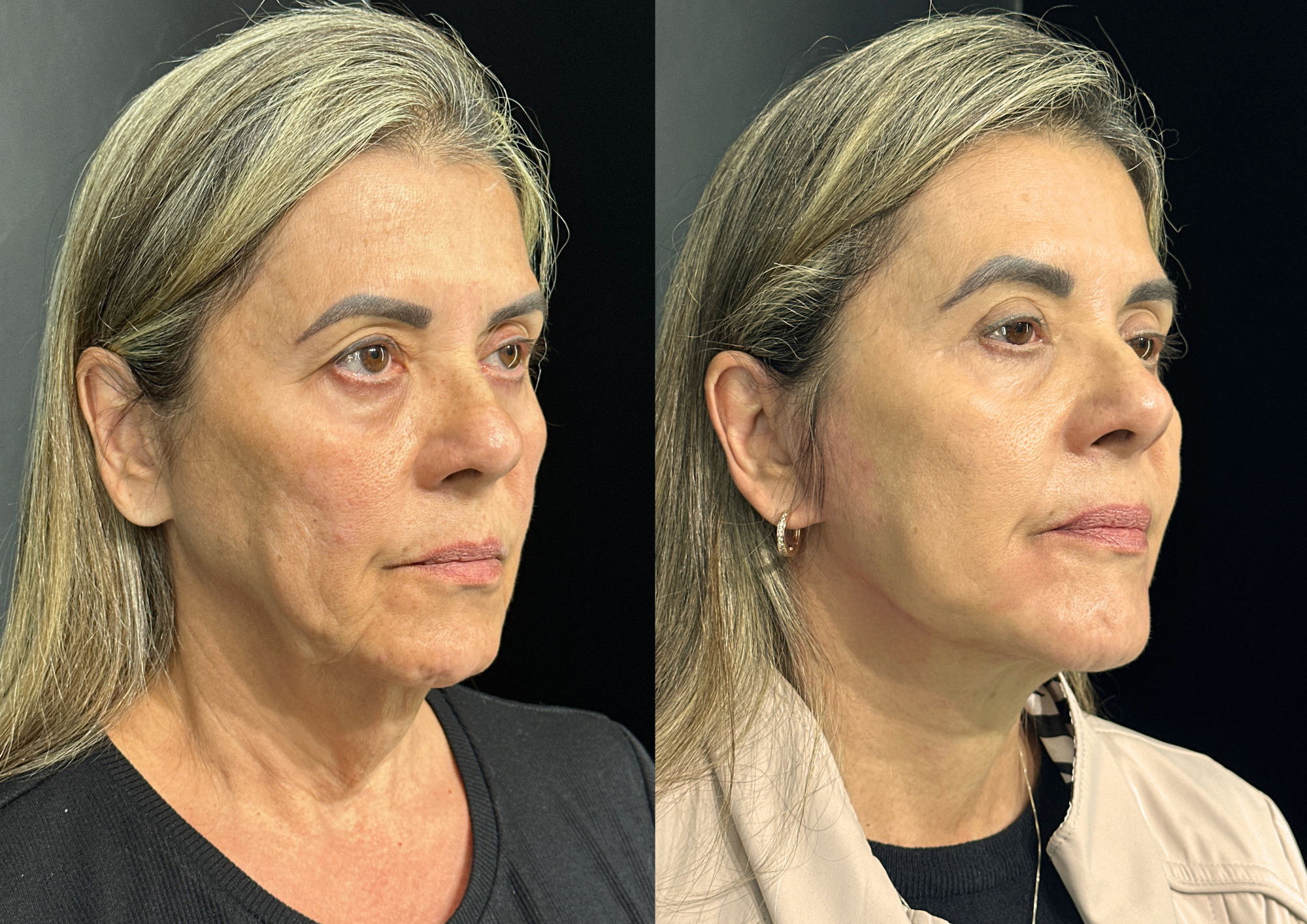 Before and after — Right profile