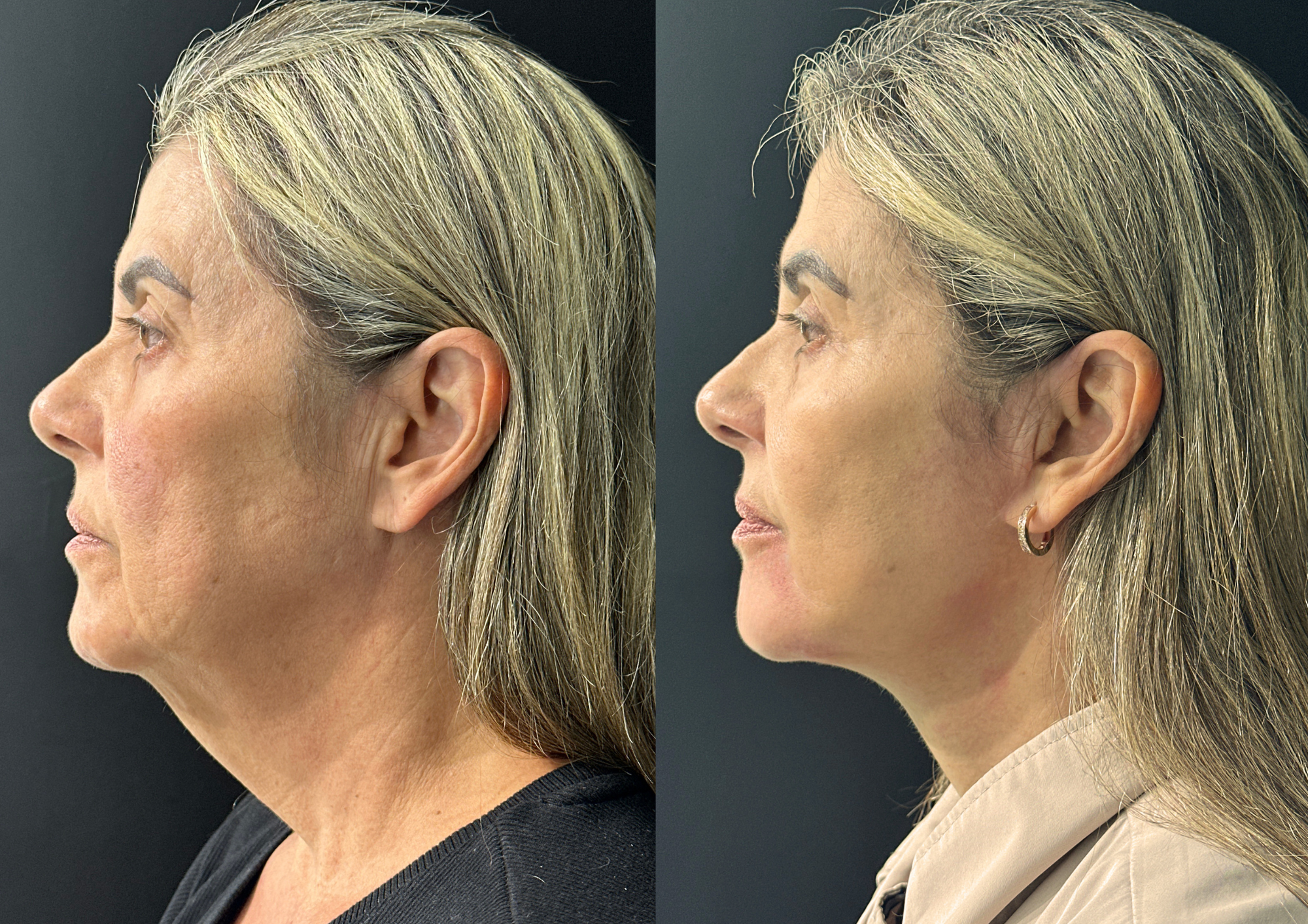 Before and after — Left profile