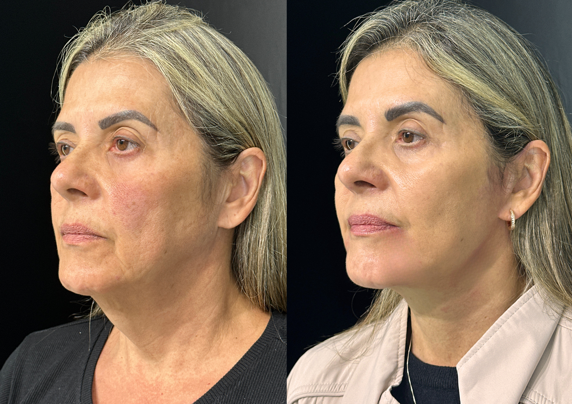 Before and after — 45° right