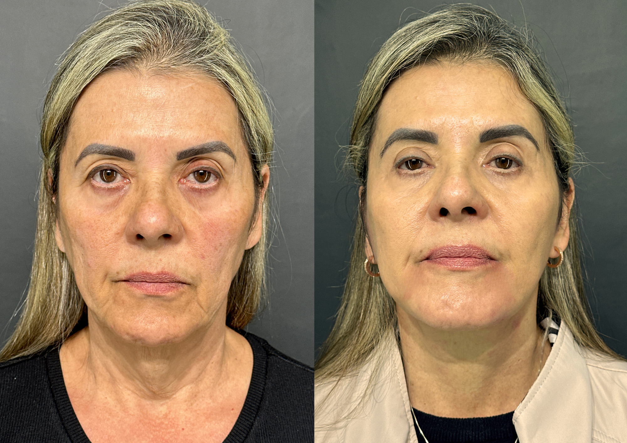 Before and after — 45° left