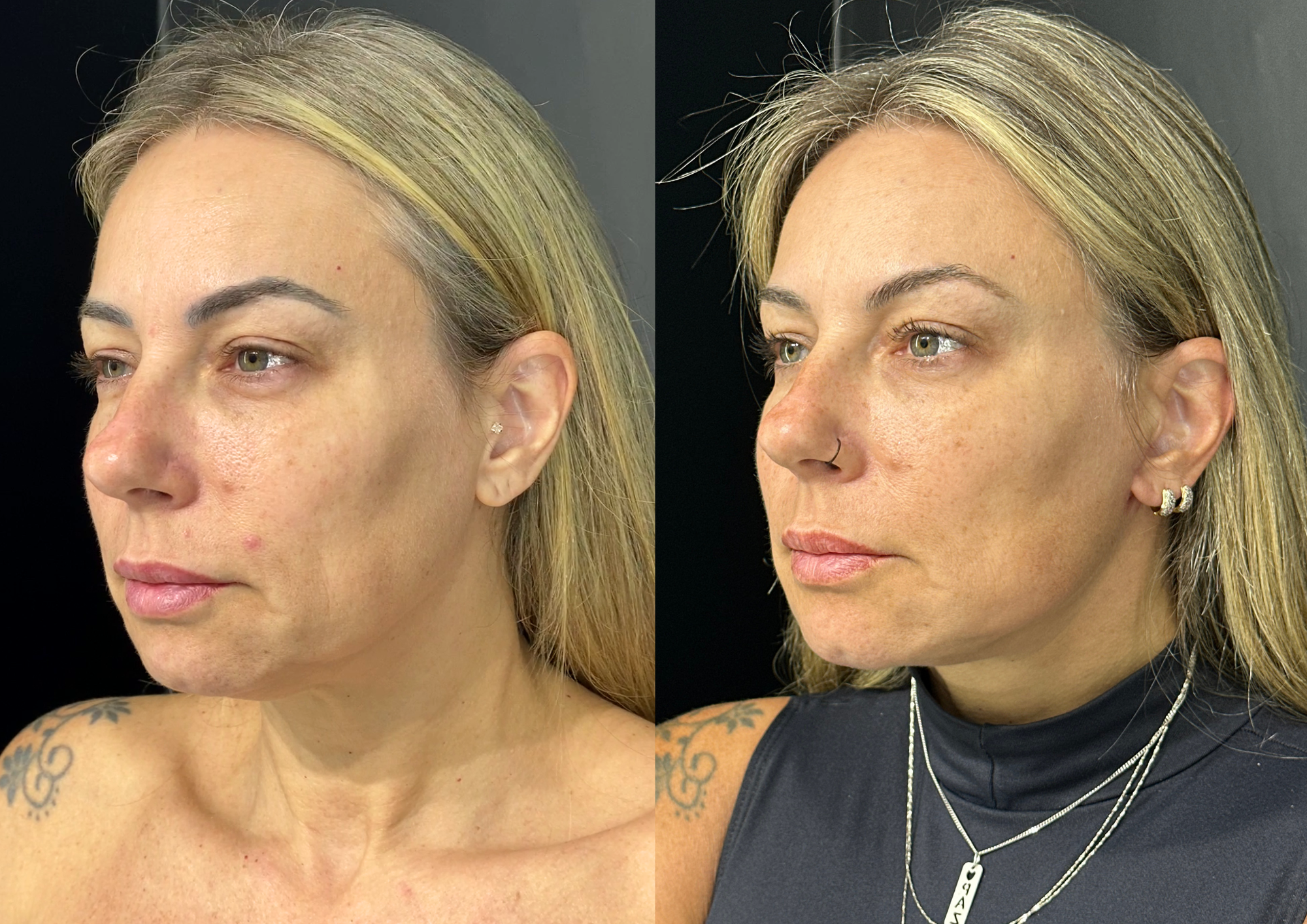 Before and after — Front