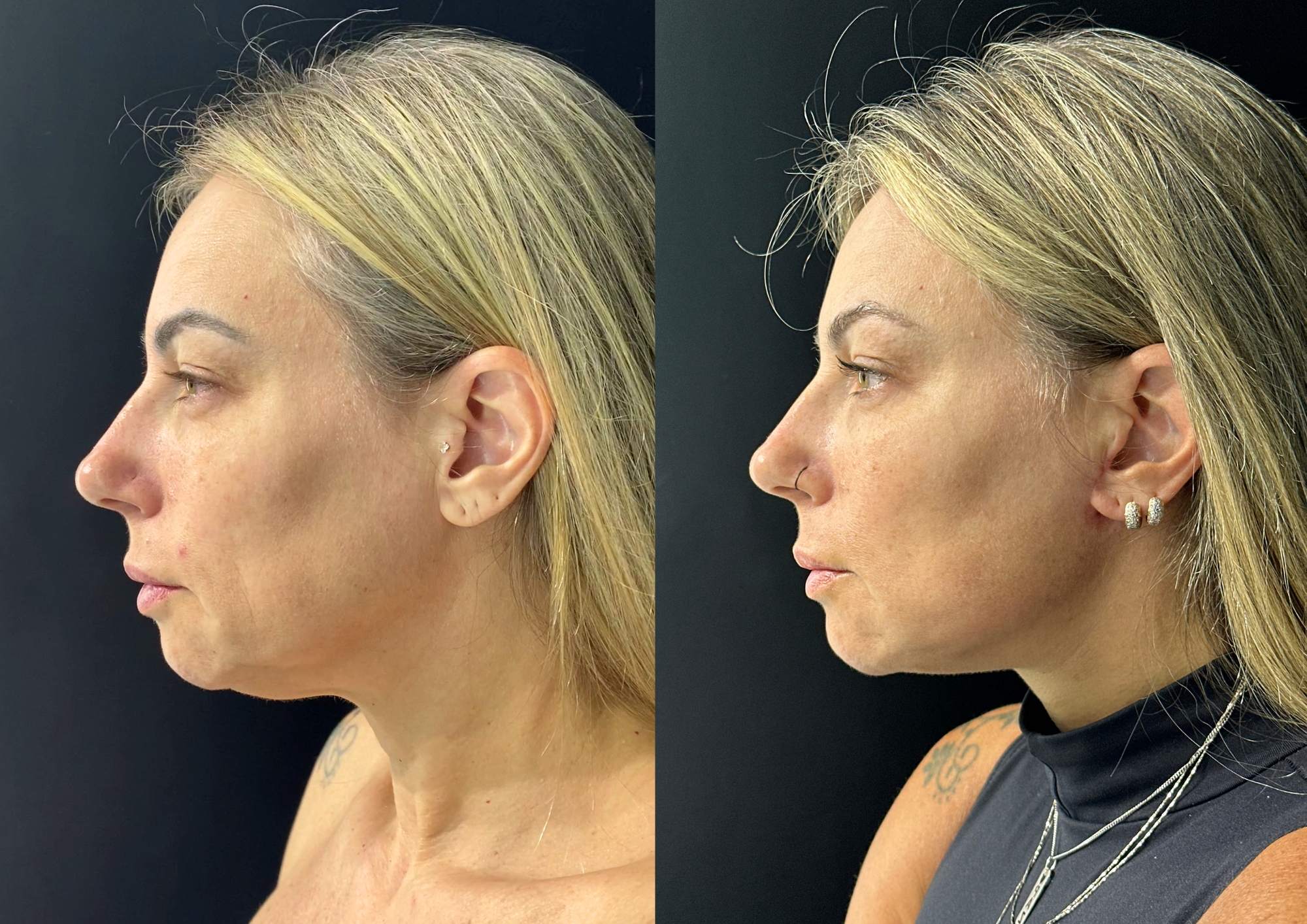 Before and after — Right profile