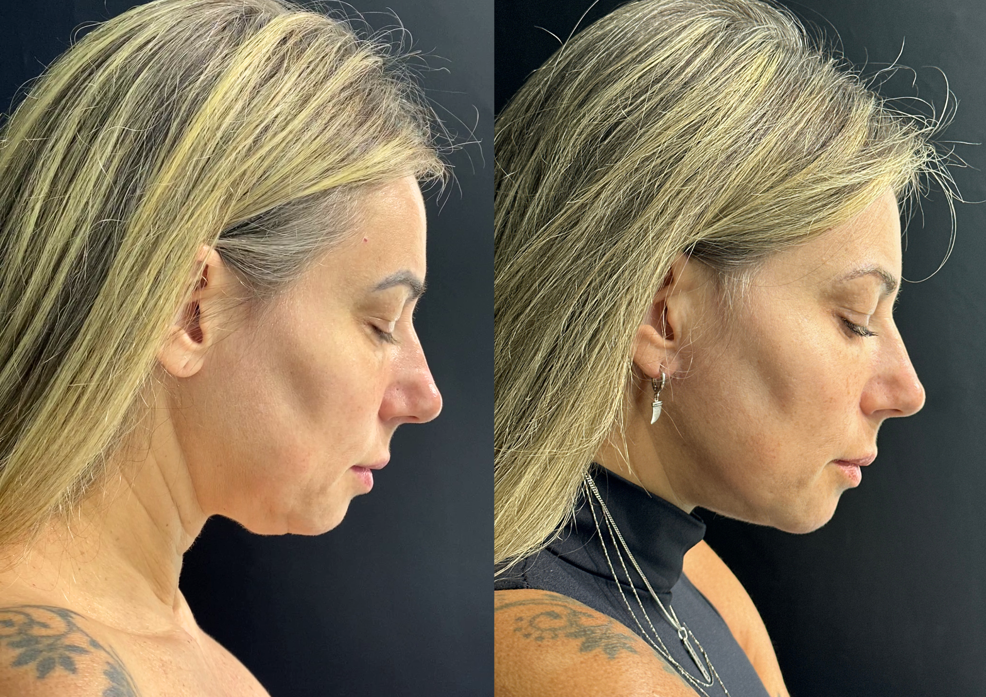 Before and after — Left profile