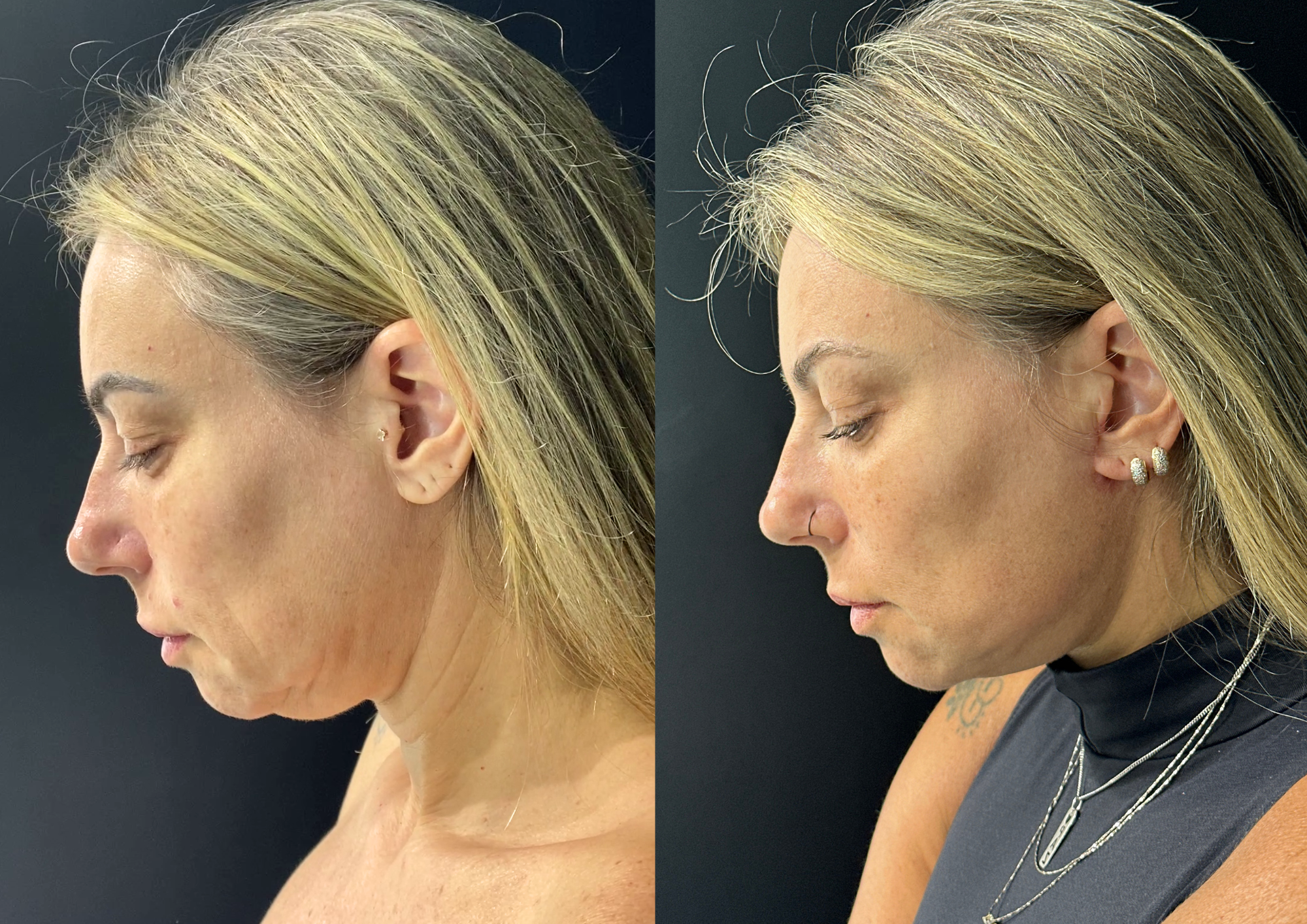 Before and after — 45° right
