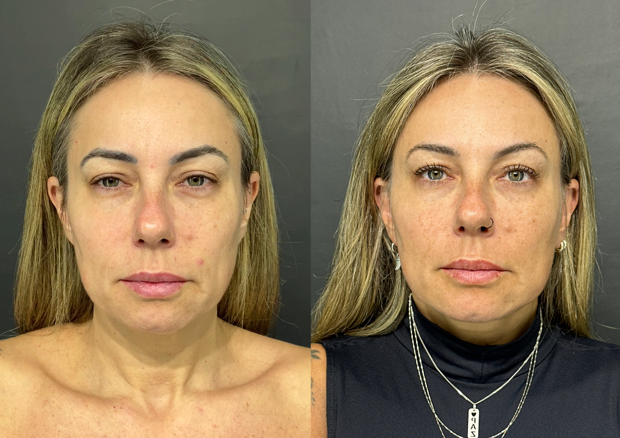 Before and after — 45° left
